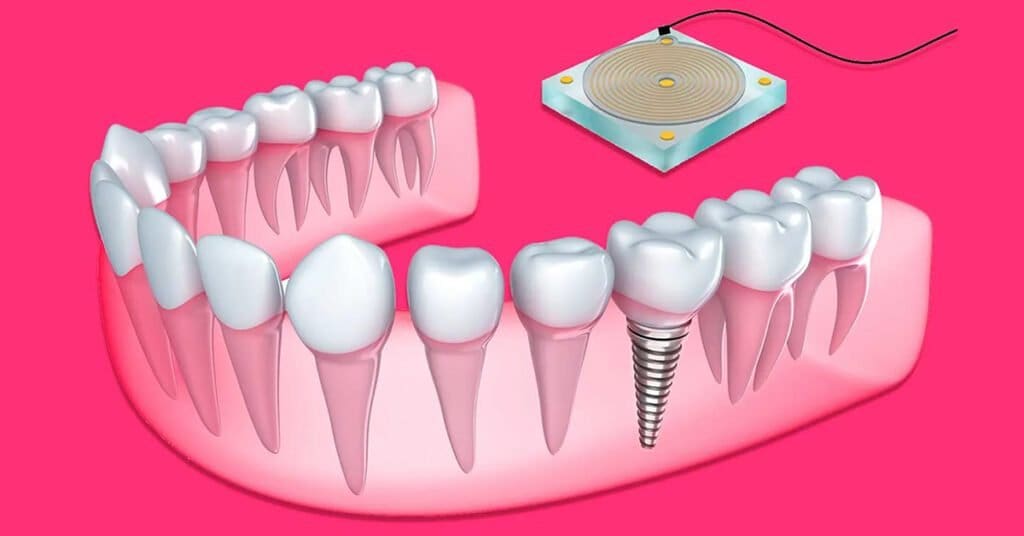 Smart Dental Implants | IoT Dental | Dental Resource Asia
