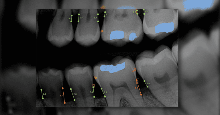 Overjet's AI-Powered Caries Assist Aids Caries Detection_Dental Resource Asia