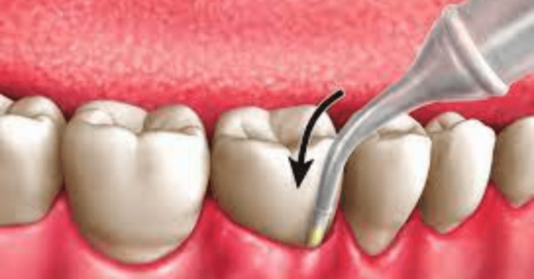 Study Indicates ARESTIN Antibiotic Reduces Periodontitis Pathogens_Dental Resource Asia