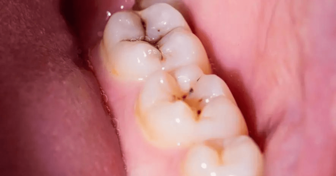 Natural Molecule DIM Shows Remarkable Potential in Dental Care