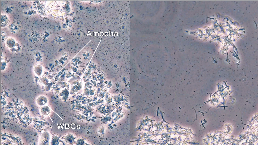 Fig. 11: Amoeba and WBCs with a high bacterial load in the background (left), No amoeba nor WBCs with much less background bacteria after antiparasitic antibiotics (right)