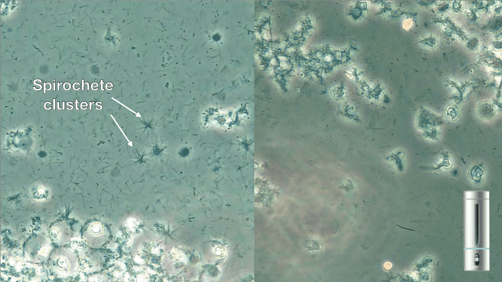 Fig. 6: Clusters of spirochetes and many background spirochetes (left), Few spirochetes (right)