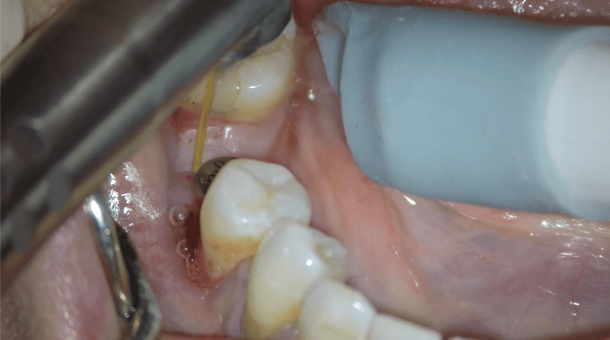 Fig. 7: Laser Assisted Peri-Implant Treatment with ozonated water