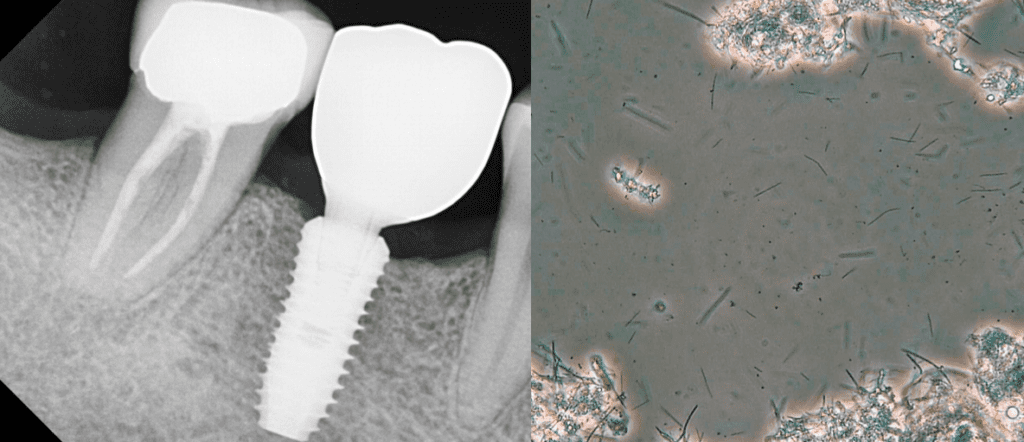 Fig. 9: 15 months post-implant placement (left), healthy biofilm (right)