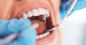 Oral Microbiome Transplants Show Promise in Preventing Dental Decay, Study Reveals_Dental Resource Asia