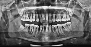 Study Shows Promise of Antimicrobial Peptides in Treating Severe Periodontitis_Dental Resource Asia