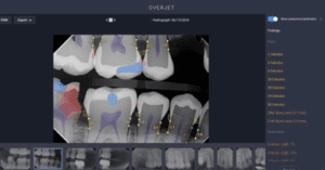 Overjet Introduces AI-Powered Educational Tool_Dental Resource Asia