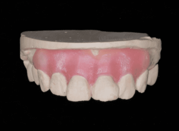 Figure 3 Wax up on working cast