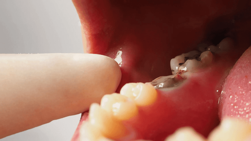 72% of Filipinos Affected by Tooth Decay