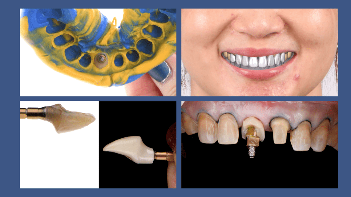 Case Report: Clinical Strategies and Considerations in Aesthetic Rehabilitation