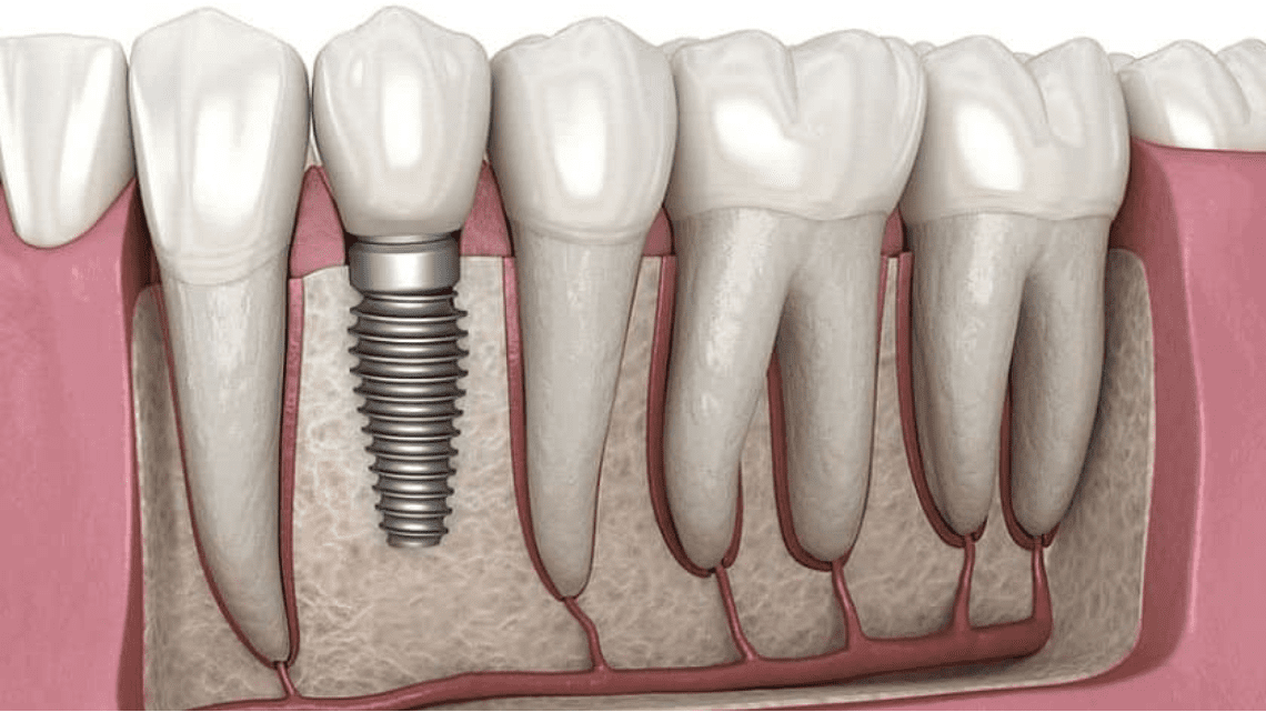 Dental Implant Industry Under Scrutiny Following Patient’s Legal Challenge