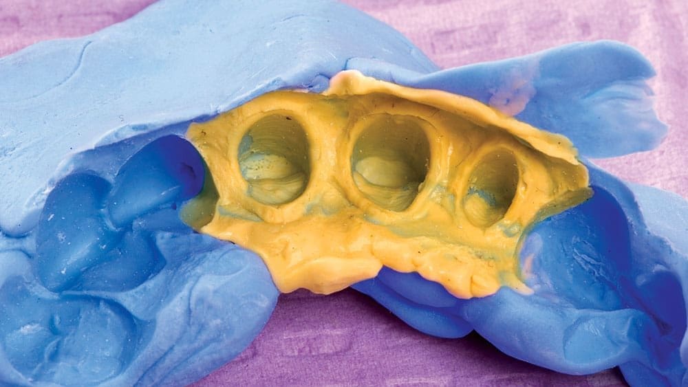 Fixed prosthetic impressions