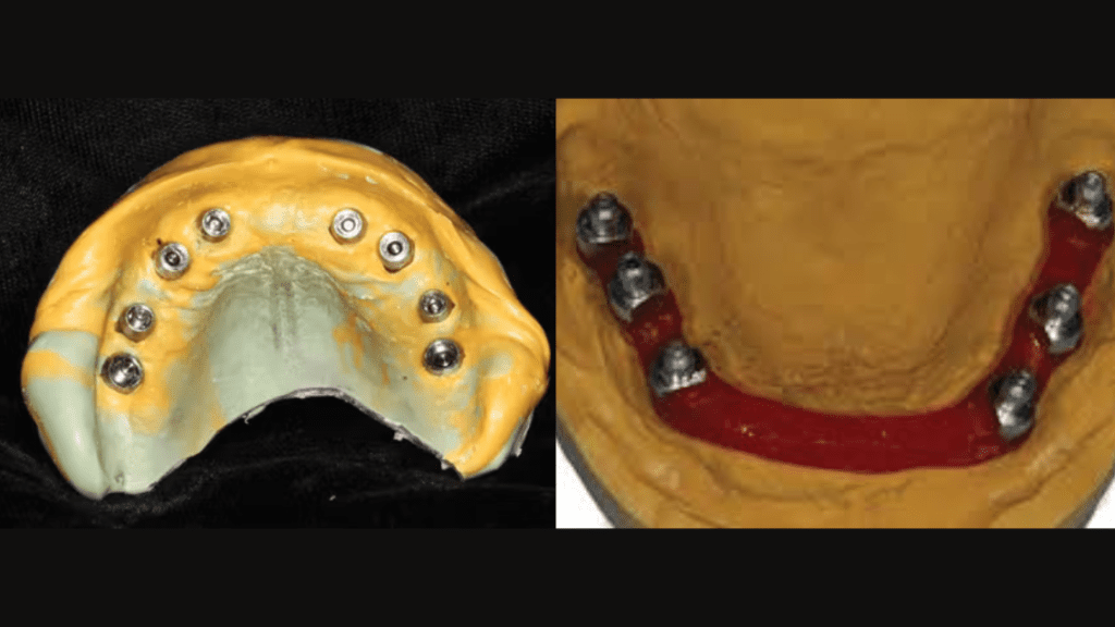 full arch dental impression
